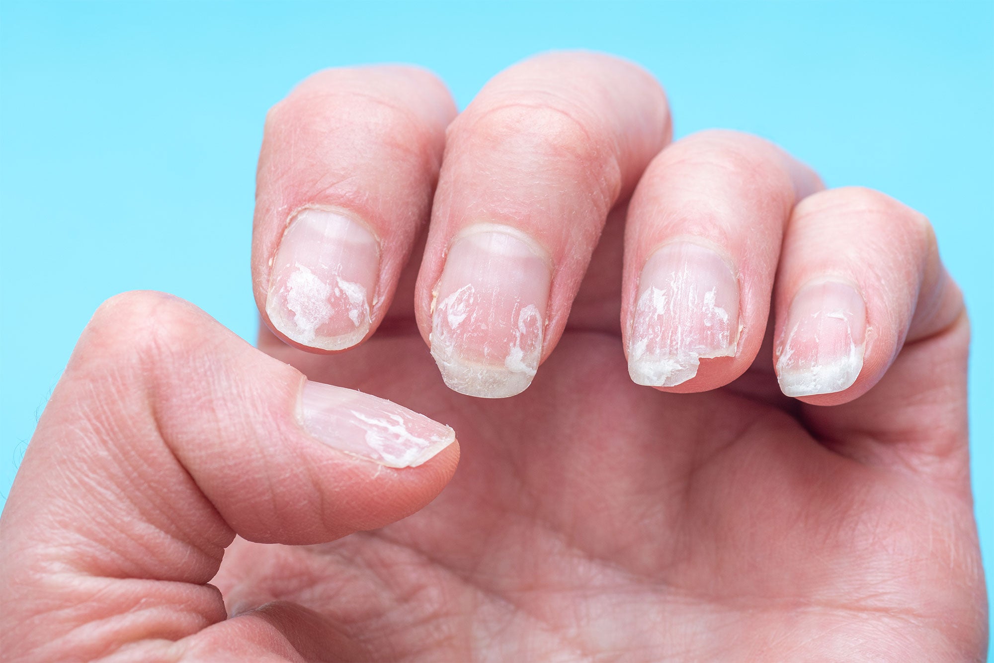 Understanding Nail Damage - Causes and Solutions for Salon Professionals